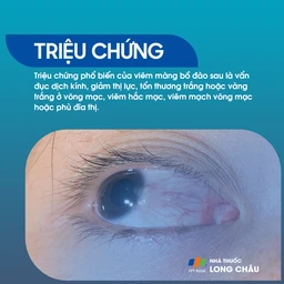 Viêm màng bồ đào 2