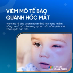Viêm mô tế bào quanh hốc mắt 1