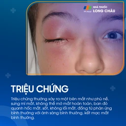 Viêm mô tế bào quanh hốc mắt 2