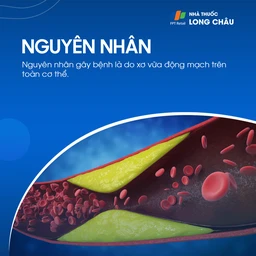 Hẹp động mạch cảnh 3