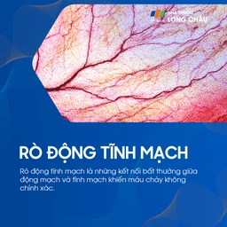 rò động tĩnh mạch 1