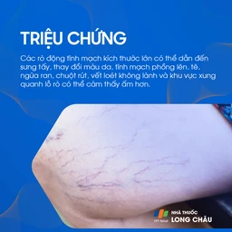 Rò động tĩnh mạch 2