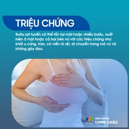 Bướu sợi tuyến 2