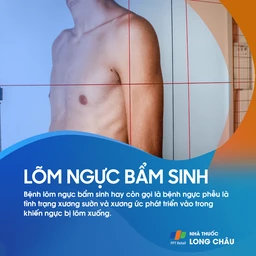 Lõm ngực bẩm sinh 1