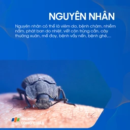 Phát ban ở ngực 3