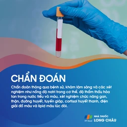 Tăng tiết ADH không thích hợp 5