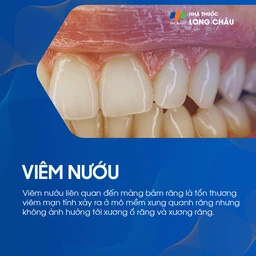 Bệnh nướu và nha chu 2