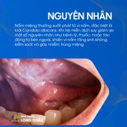 Nấm miệng 3