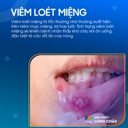 Viêm loét miệng 1