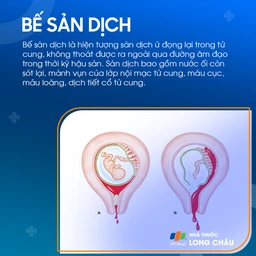 Bế sản dịch sau sinh 1