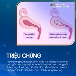 Dính buồng tử cung 2
