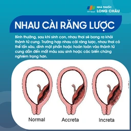 Nhau cài răng lược 1