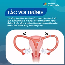 Tắc vòi trứng 1