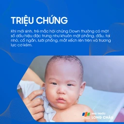 Hội chứng Down 2