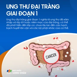 Ung thư đại tràng giai đoạn 2