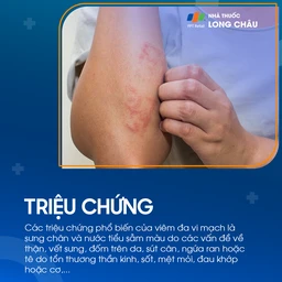 Viêm đa vi mạch 2