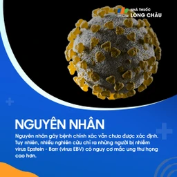Nguyên nhân chính xác chưa rõ, nhưng virus Epstein–Barr có thể làm tăng nguy cơ ung thư họng
