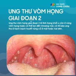 Ung thư vòm họng giai đoạn 2 - 1
