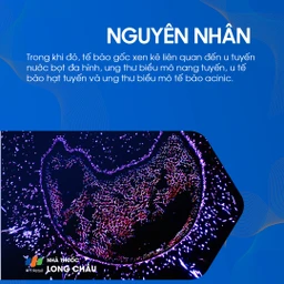 U tuyến nước bọt mang tai 5