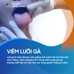 Viêm lưỡi gà 1