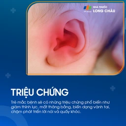 Viêm tai giữa ứ dịch 2