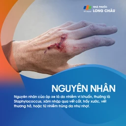 Áp xe lòng bàn tay 3