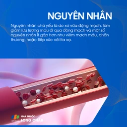 Hẹp động mạch chi dưới 3