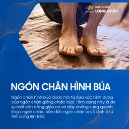 Ngón chân hình búa 1