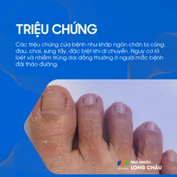 Ngón chân hình búa 2