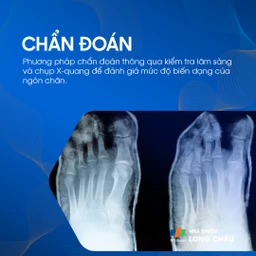 Ngón chân hình búa 5