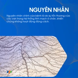 Suy giãn tĩnh mạch chi dưới 3
