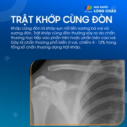 Trật khớp cùng đòn 1