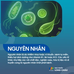 Viêm đa dây thần kinh 4