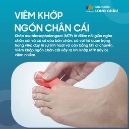 Viêm khớp ngón chân cái 1