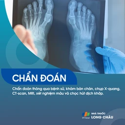 Viêm khớp ngón chân cái 5