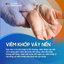 Viêm khớp vảy nến 2