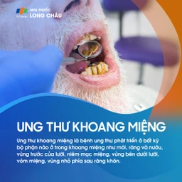 Ung thư khoang miệng 1
