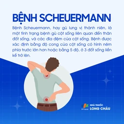 Bệnh Scheuermann 1