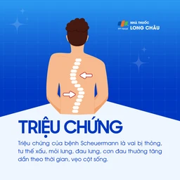 Bệnh Scheuermann 2