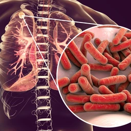 Bệnh lao là gì? Những vấn đề cần biết về bệnh lao 1