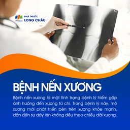 Bệnh nến xương 1