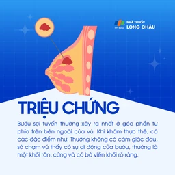 Bướu sợi tuyến vú Birads 3 2