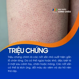 Dày sừng nang lông 2