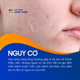 Dày sừng nang lông 4