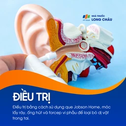 Dị vật trong tai 6