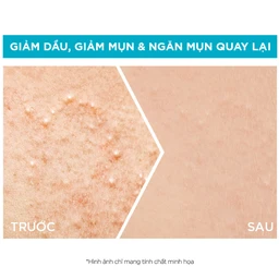 Tinh chất ngừa mụn Garnier Skin Naturals Bright Complete Anti Acne Booster Serum 30ml 4