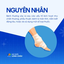 Hội chứng sudeck 3