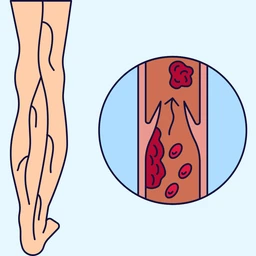 Huyết khối tĩnh mạch 1