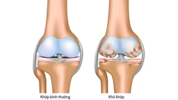 Khô khớp: Nguyên nhân, triệu chứng và phương pháp điều trị 1