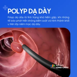 Polyp dạ dày 1